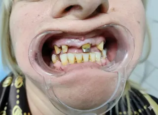 Трансформација за Паметење: Како добив Нова Насмевка со Метал Керамика и Vizil Протеза во Dental Studio Ars, Скопје!