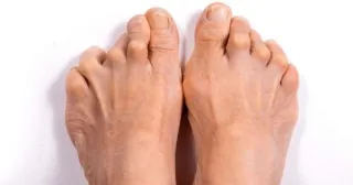 Telltale Signs of Rheumatoid Arthritis in the Feet