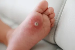 Verruca Treatment: Effective Solutions for Removing Warts from Your Feet