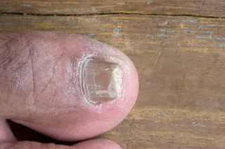 Are Your Toenails Telling You Something? Signs You Should See a Chiropodist