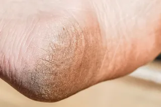 Fissures vs. Dry Skin: What’s the Difference and Why It Matters