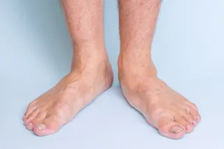 Flat Feet and Running: Tips to Prevent Injury and Improve Comfort