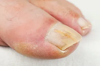Thick, Discoloured Toenails? It Might Be a Fungal Infection