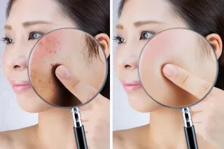 The Best Ways To Remove Age Spots