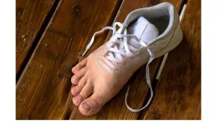 Fungal Infections