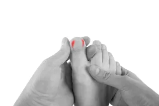 Ingrown Toenails