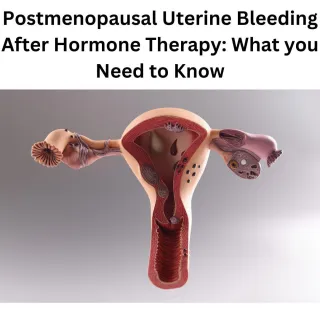 Postmenopausal Uterine Bleeding After Hormone Therapy: What You Need to Know