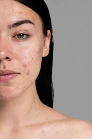 Tackling Acne by Balancing Blood Sugar and Hormones