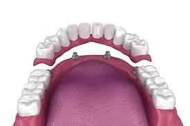 The True Lifetime Cost of Tooth Loss: Why Dental Implants at Osuna Dental Care Are the Most Affordable Long-Term Solution in Albuquerque