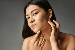 How to Treat Acne-Prone Skin