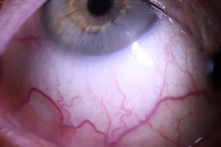 The Value of Including the Sclera in an Eye Assessment