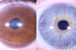 Pupil Size & Shape in an Iris Assessment