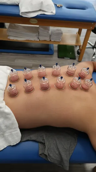 How Cupping is Used in Physical Therapy