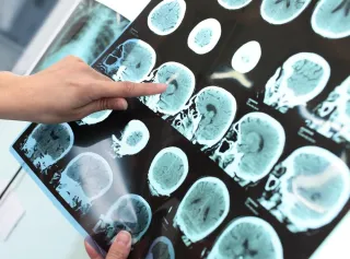 Memory Problems Could Signal Stroke Risk