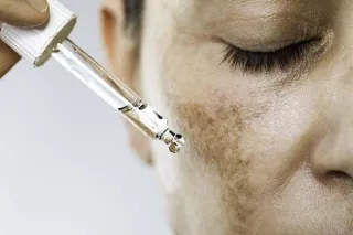 Understanding Hyperpigmentation: Causes, Prevention, and Treatment