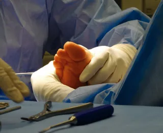 Callos y durezas: por qué aparecen y cuándo tratarlos