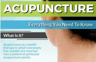 Acupuncture – Everything You Need to Know