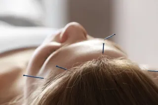 Acupuncture Beats Drug For Insomnia Relief