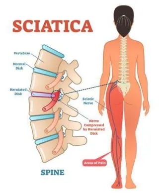 Top 5 Most Common Symptoms of Sciatica