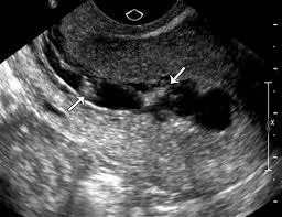 Asherman Syndrome: Understanding a Silent Reproductive Challenge