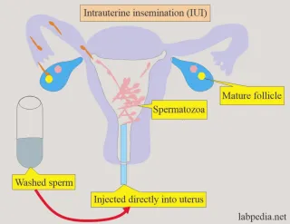 Natural vs. Medicated IUI Cycles: What to Expect Each Step of the Way