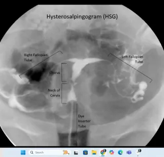 Pre-IUI Testing & Ultrasound Timing: How Doctors Prep the Body for Fertility Treatment