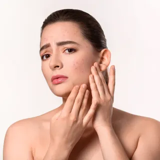 What Causes Adult Acne (and How to Treat It Safely)
