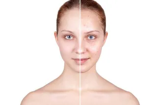 Acne & Clear Skin Treatments