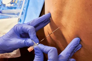 EPIDURAL LYSIS OF ADHESIONS
