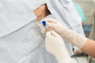RACZ PROCEDURE