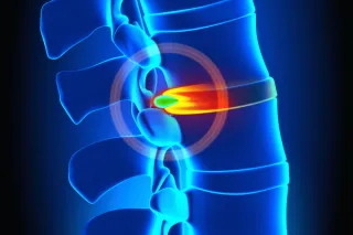 PERCUTANEOUS DISCECTOMY