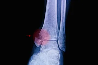 MEDIAL BRANCH BLOCKS