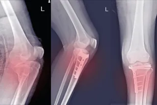 KYPHOPLASTY