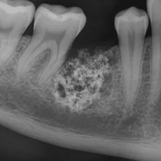 COME SI MANIFESTA E SI TRATTA L'OSTEONECROSI DELLA MANDIBOLA?