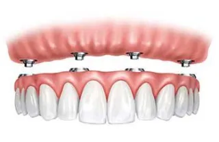 Rediscover Your Smile: Full Mouth Dental Implants