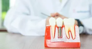 Understanding Dental Implants: Cost, Benefits, and More