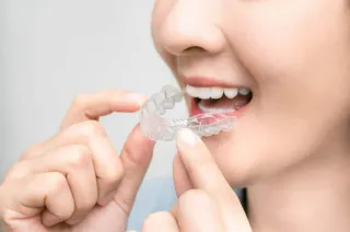 The Benefits of Invisalign Over at Home Methods