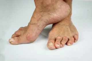 Can Physiotherapy Help with Chronic Conditions Like Arthritis?