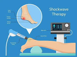 Unlocking Healing: Shockwave Therapy and Chiropractic Care for Optimal Wellness