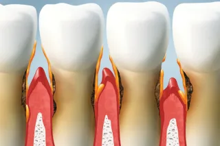 Gum Health