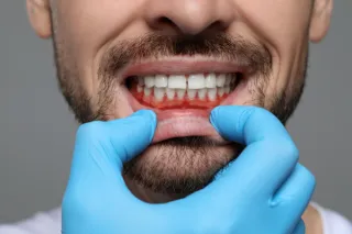 What is Gum Recession?