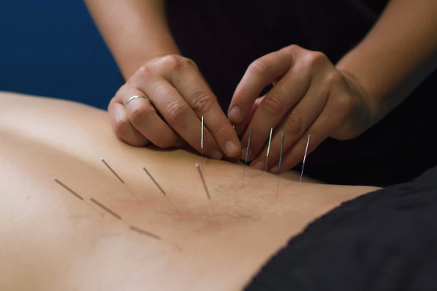 Dry Needling: How It May Help You