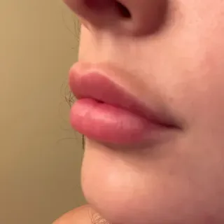 Lip Filler Migration