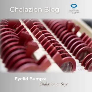 Chalazion: Understanding the Bump on Your Eyelid