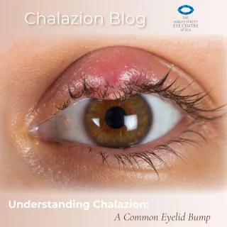 Understanding Chalazion: A Common Eyelid Bump