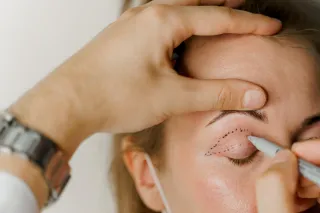 Unlocking a Youthful Look: Your Surgical Journey to Addressing Under Eye Bags