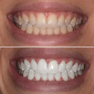 Withen Your Teeth Without Toxic Chemicals...