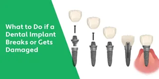 What to Do if a Dental Implant Breaks or Gets Damaged