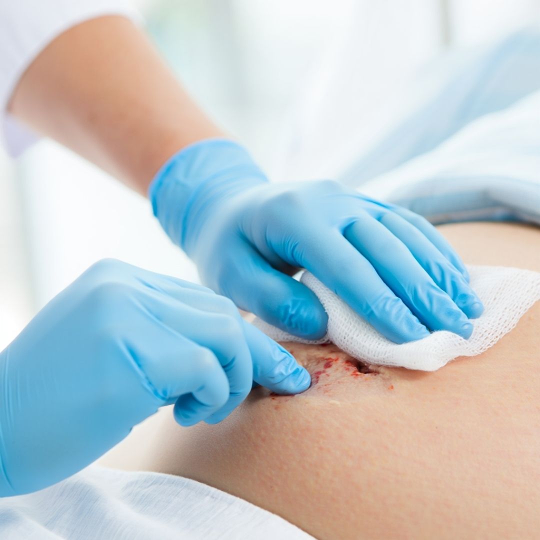 Wound Dressing for Pressure Ulcers: Best Practices and Uses