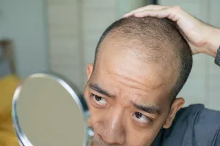 Understanding Male Baldness: A Comprehensive Guide